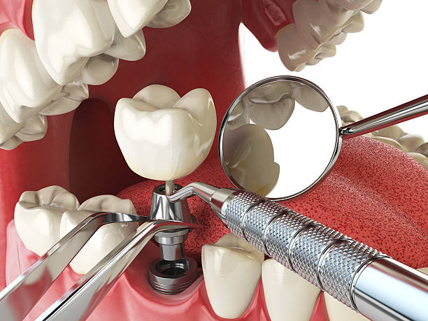 Best Broken or Chipped Tooth Repair in Edgerton, KS
